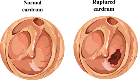 Perforated eardrum