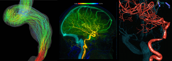 pulsatile tinnitus or Hear A Pulse In My Ear