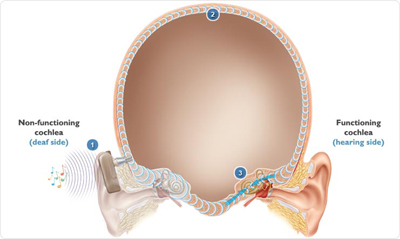 What causes hearing loss in one ear