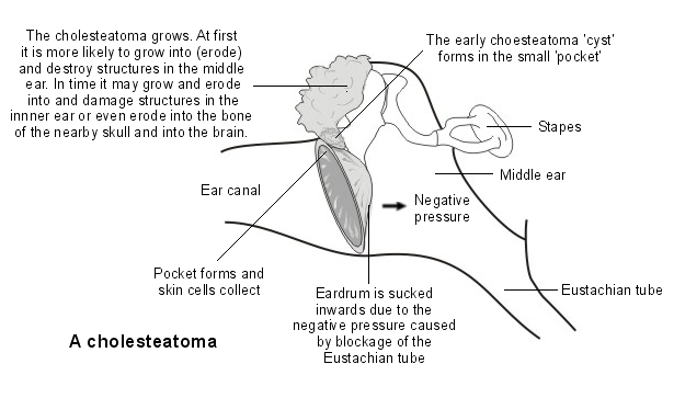 Causes of Cholesteatoma