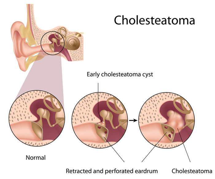 Symptoms of Cholesteatoma