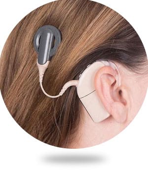Cochlear implantation
