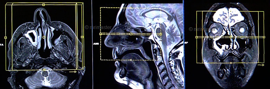 MRI