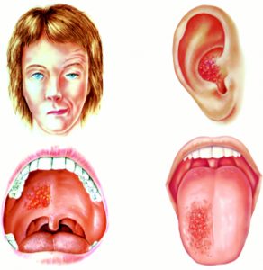 Ramsay hunt syndrome