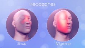 Sinus Vs Migraine