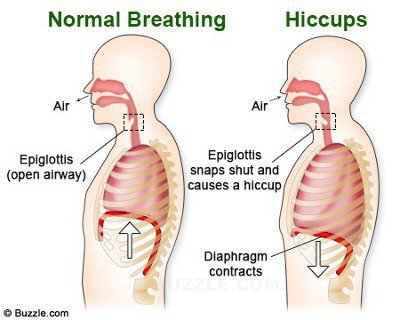 Hiccups