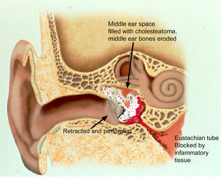 cholesteatoma and hearing loss