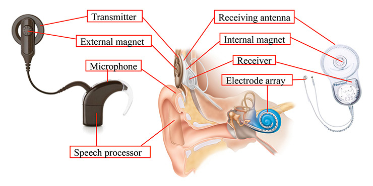 Cochlear implant parts