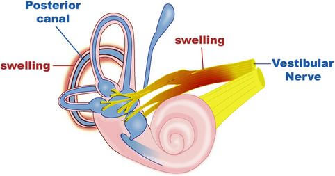 Labyrinthitis