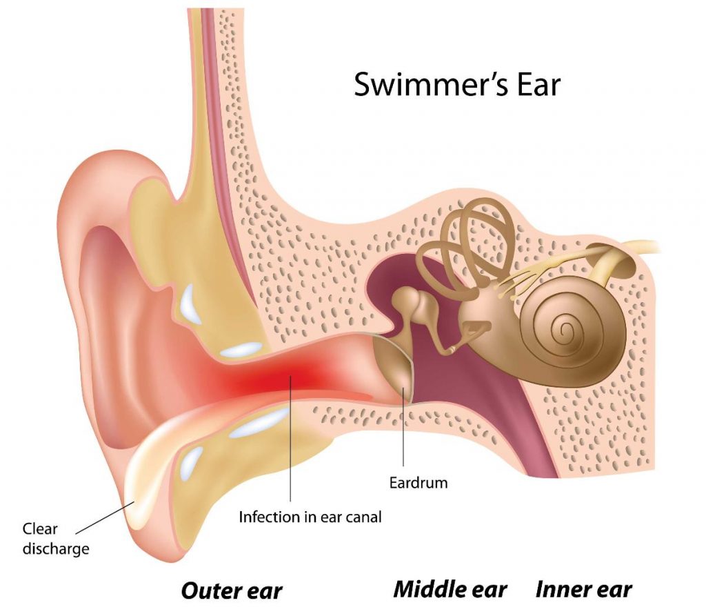 Swimmers ear