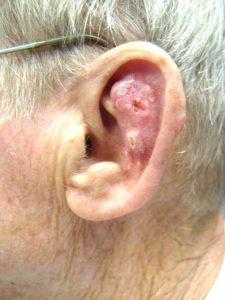 Basal Skin Carcinoma