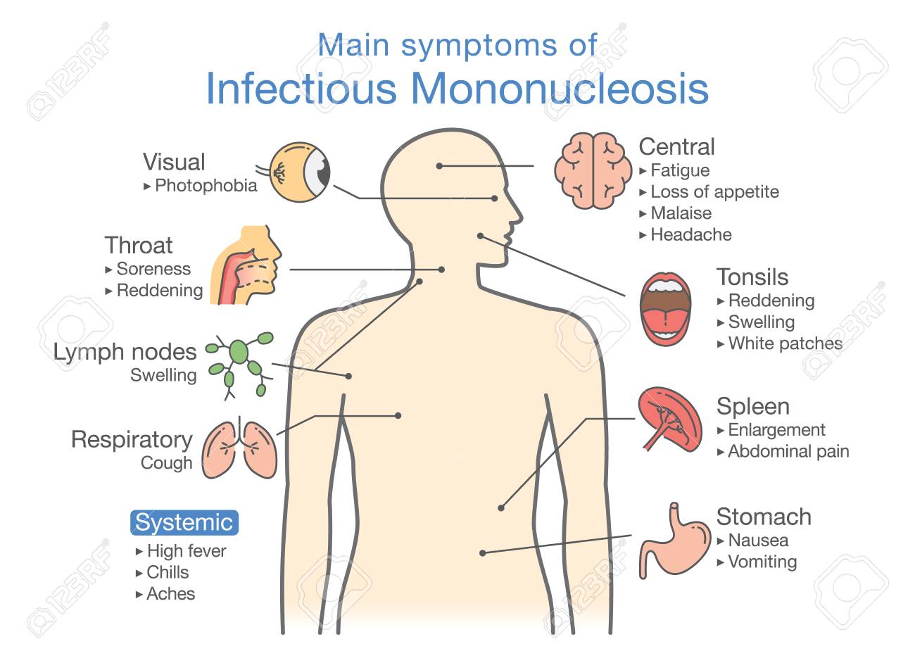 Infectious Mononucleosis