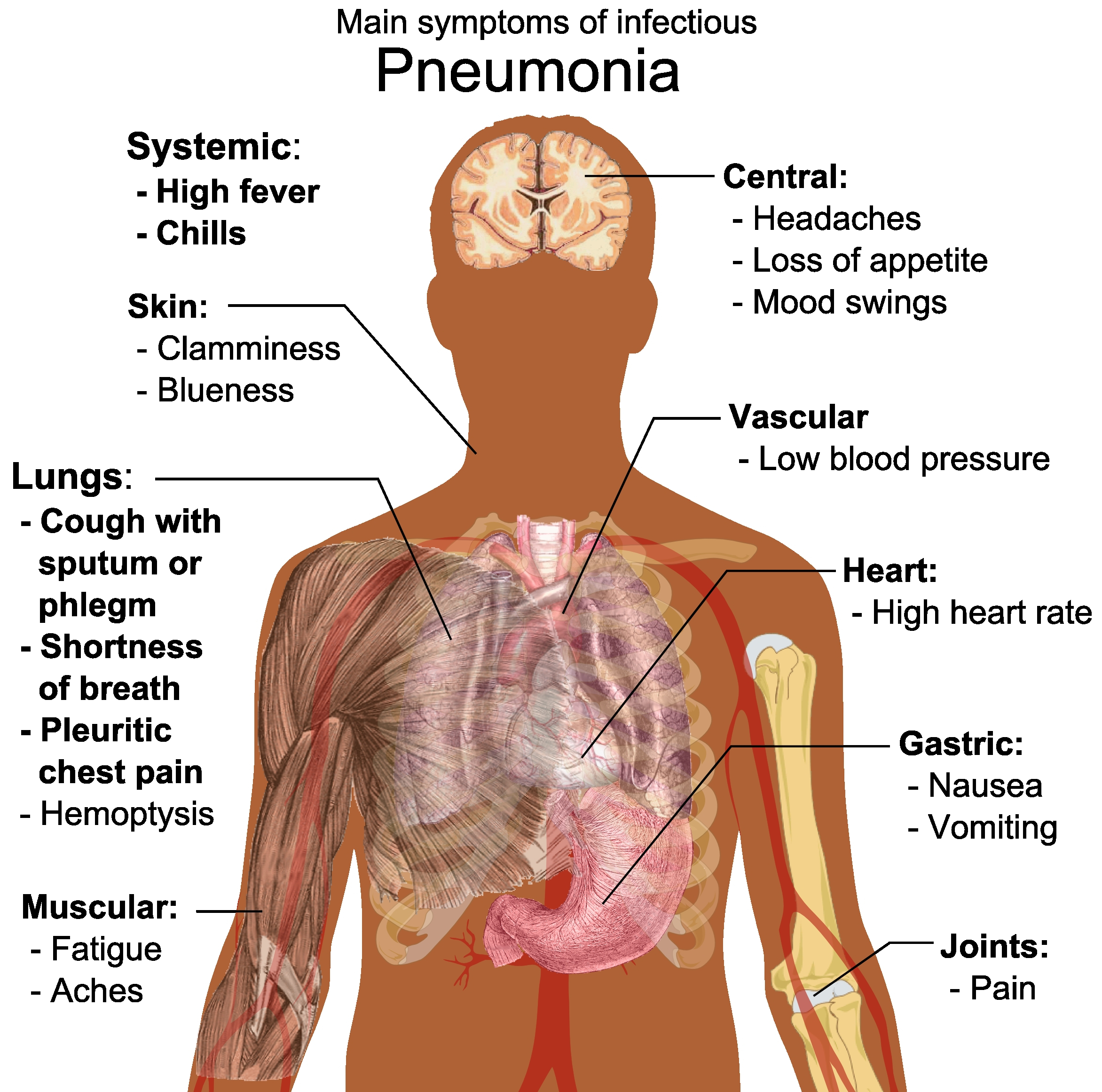 Pneumonia