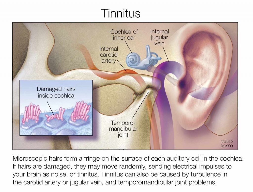 tinnitus