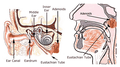 Enlarged Adenoids