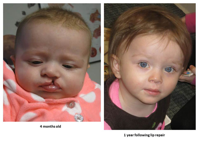 Before and After Cleft Lip Surgery