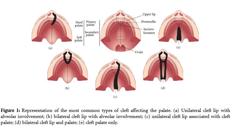 Cleft Lip and Cleft Palate Anatomy