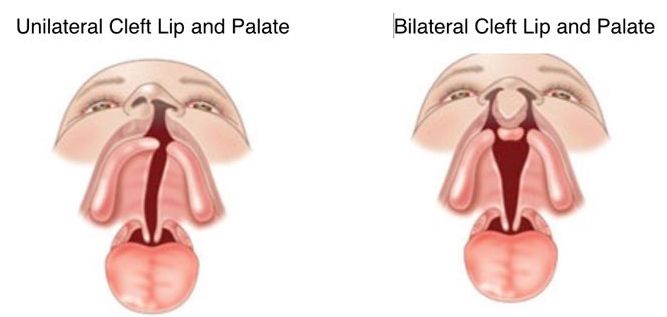 Unilateral and Bilateral Cleft Palate