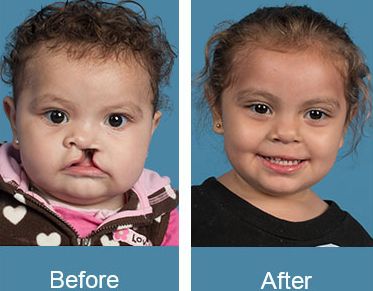 Before and After Cleft Palate Surgery