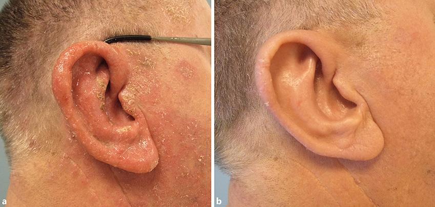 Ear Eczema