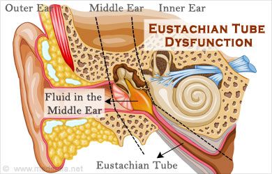 Ear Fluttering by Eustachian Tube Dysfunction