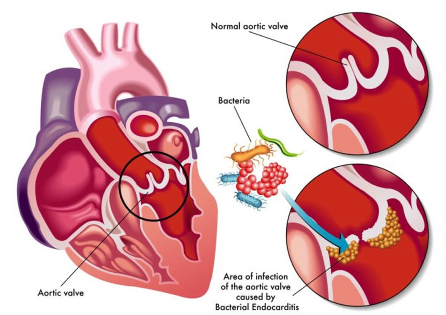 Infective Endocarditis