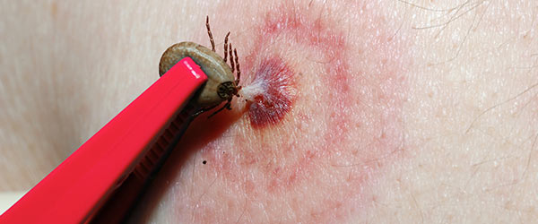 Lyme Disease