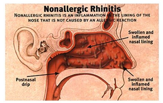 Non-allergic Rhinitis