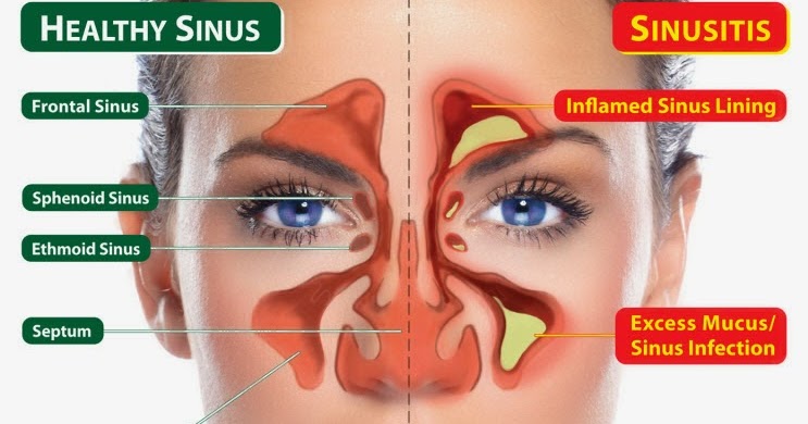 Sinusitis