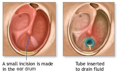 Ear Tube