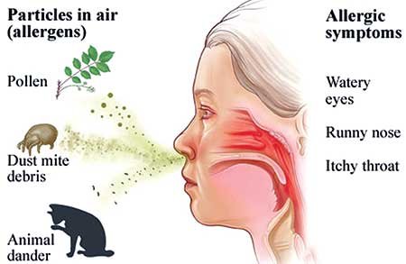 Allergic rhinitis causes