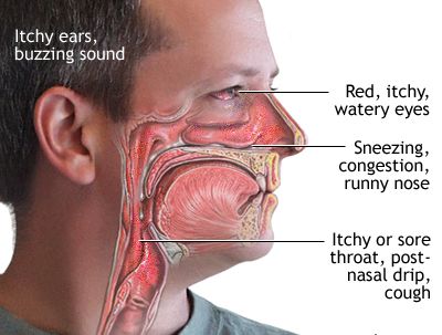 Allergic Rhinitis Symptoms