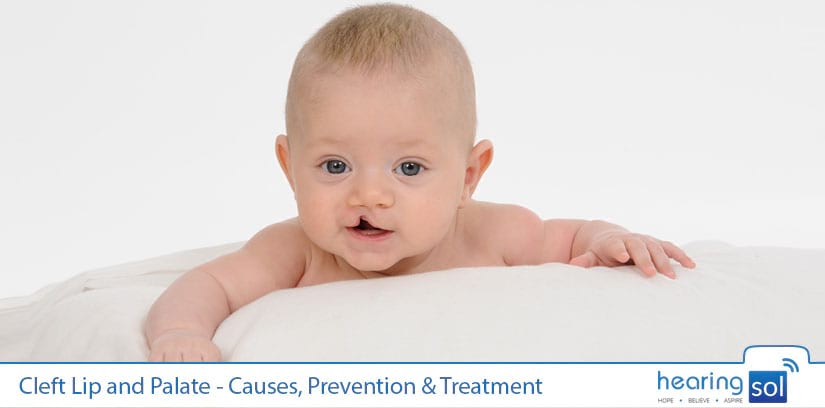 Cleft Lip and Palate - Causes, Prevention & Treatment