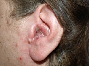Allergies And Ear Pain