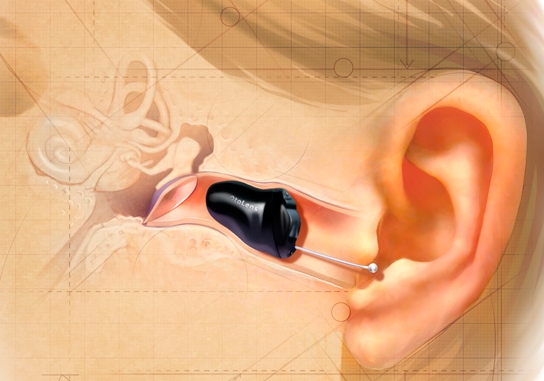 Invisible Hearing Aid