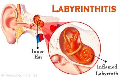 Labyrinthitis