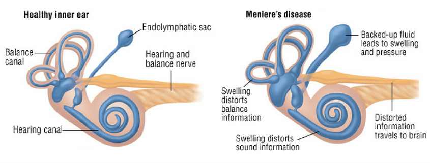 Meniere's diseased