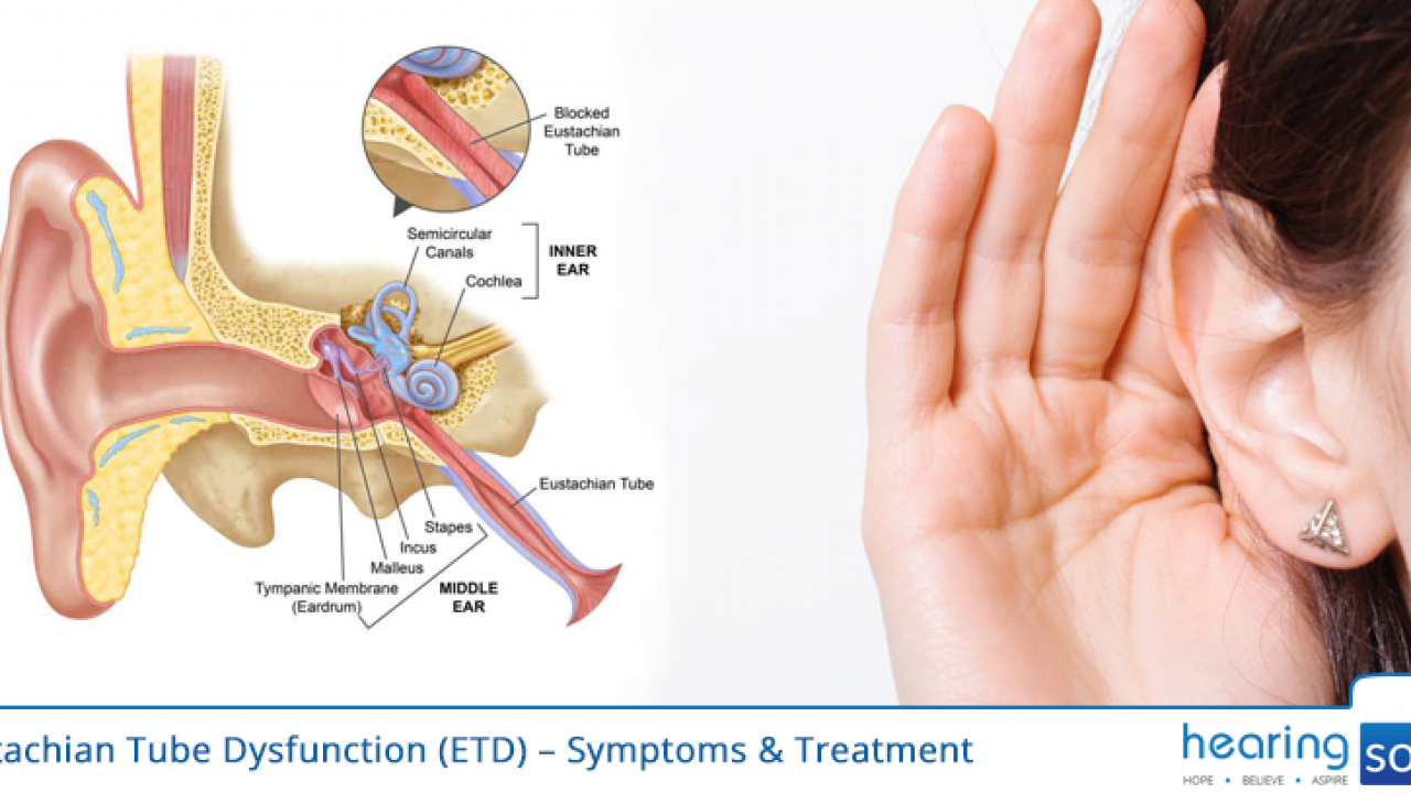Eustachian Tube Dysfunction Remedies eustachian-tube-dysfunction-remedies